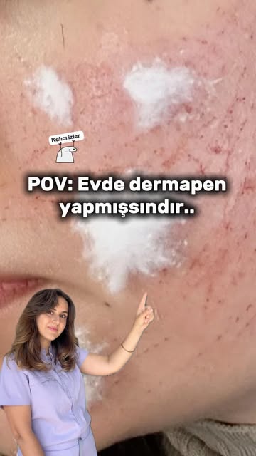 Son zamanlarda yüzünde evde yapılan dermapen sonrası çizikler, enfeksiyon, kalıcı izler, sivilcelenm