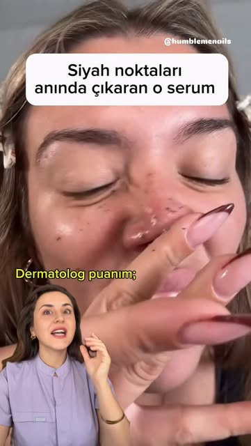 Siyah noktaları saniyeler içinde çıkaran o ürünü Dermatolog gözüyle puanlıyorum ! 

Marka görünüyor 
