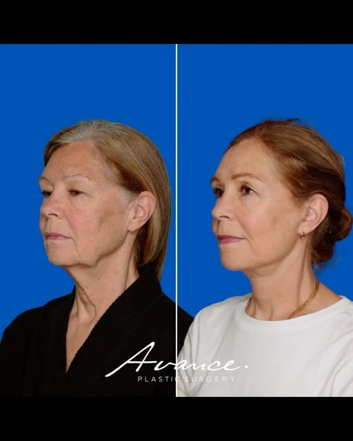68 years old. 3 months apart.

This patient underwent a deep plane face and neck lift, blepharoplast