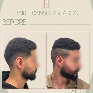 حاله تكثيف اللحيه بعد اسبوع من الإجراء 

From patchy to perfectly define
A natural beard transplant 