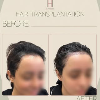 حاله تصغير جبهه لسيده باستخدام زراعه الشعر بعد اول اسبوع من الإجراء مع الاحتفاظ بالشعر بدون حلاقه

A