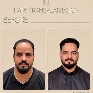 نتيجة مميزة بعد ٦ أشهر فقط من إجراء زراعة الشعر مع د. علاء حجاج 
استعادة طبيعية للكثافة وخط شعر متنا
