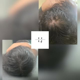 ✨ Scalp Micropigmentation bei Frauen für sichtbar mehr Haardichte ✨

Schon nach der 1. Behandlung is