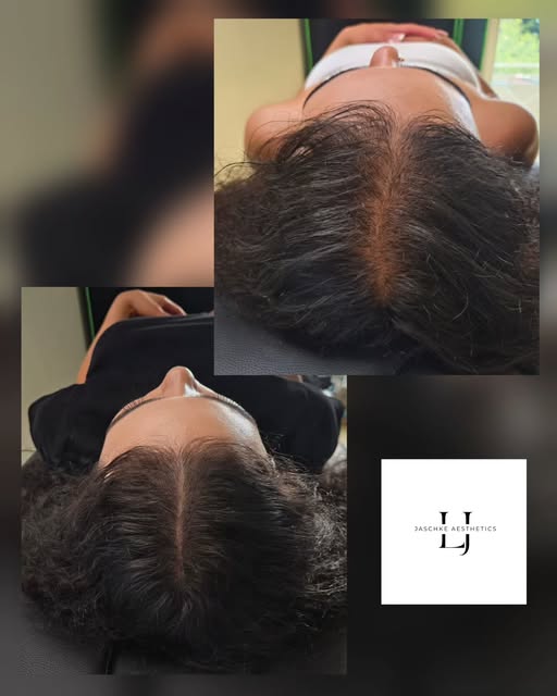 🖤 Mehr Dichte. Mehr Selbstbewusstsein. 🖤

⚜️ Das Ergebnis einer abgeheilten Scalp Micropigmentatio