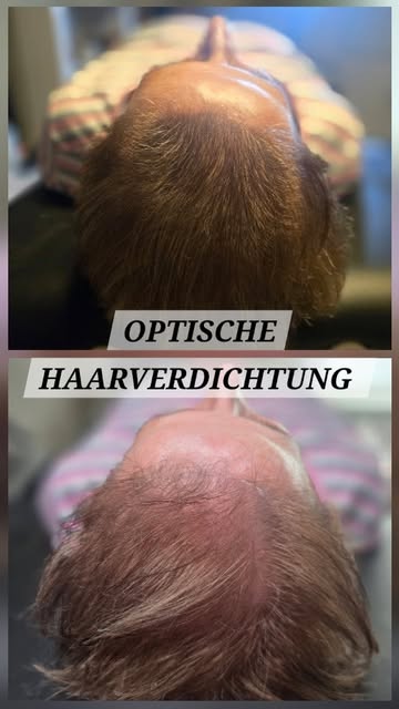 ✨️ Mehr optische Haardichte mit SMP ✨

Wenn das Deckhaar am Oberkopf und Wirbel immer lichter wird, 
