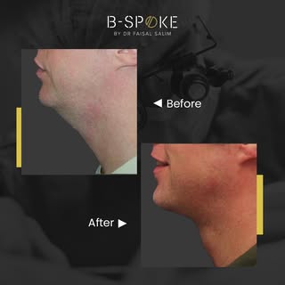 A mini face and neck lift was performed to redefine this man’s jawline. Excess tissue in the neck wa