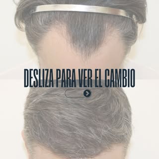 Hay cambios que no necesitan explicación. Solo un “desliza”. ✨

#HairAndBe #InjertoCapilar #Trasplan