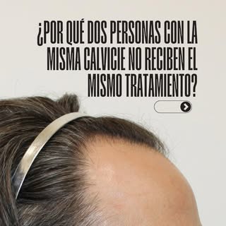 Dos personas pueden tener el mismo grado de calvicie… y necesitar tratamientos completamente diferen