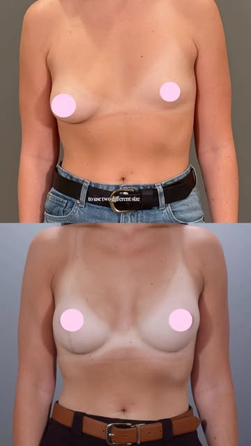 Asymmetric breasts aren’t just a cosmetic frustration - for patients with tuberous breasts, it’s oft