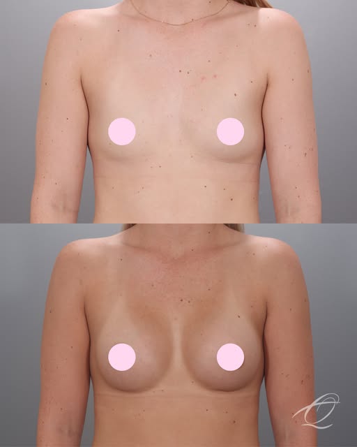 The look she wanted? Natural. The result? Exactly that.

Three months post-op and this augmentation 