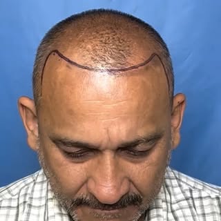 Watch this 49-year-old patient’s transformation after just 1,656 grafts using FUE technique.
Designe