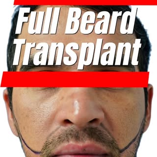 From patchy to powerful. 💪
Over 2,000 grafts meticulously placed for a full, natural-looking beard 