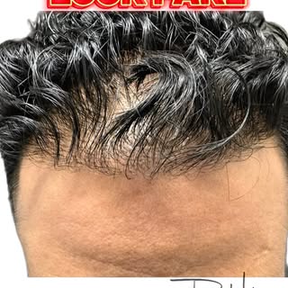 🚨Why Hair Transplants Look Fake🚨  Not all hair transplants are created equal.
A natural hairline s