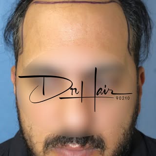 Hairline restored. Beard refined. Face framed. 

Procedure: FUE Hair Transplant + Beard Touch-Up
Gra