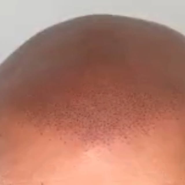 "What does it cost?" Straight talk on pricing.

Pricing runs from around £250 for an early hairline 