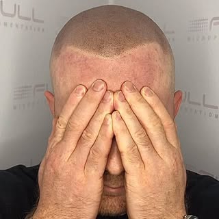 3rd session, light brown with a widows peak 🤎🤍🖋️

#scalpmicropigmentation #fullmicro #hairtattoo 
