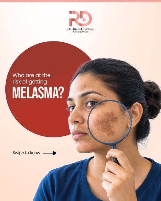 Dark patches on your face that keep coming back? It could be melasma.

Melasma is often linked to a 