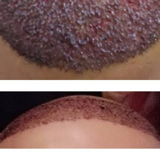 🔹Alhamdullilah Alhamdullilah we have already done here successful Hair Transplantations with PRP.
�