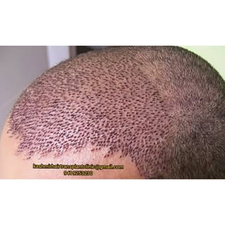#KashmirHairTransplantClinic 
#KashmirHairTransplant
#hairtransplant 
#HairTransplantSrinagar
#HairT