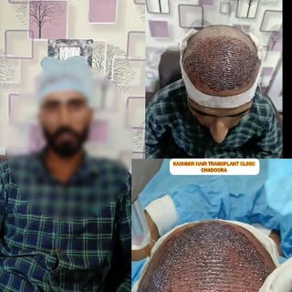 Great news for those facing hair loss or baldness! Get a **free consultation** and the most affordab