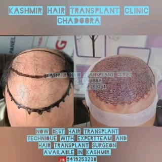 Regain Your Confidence at Kashmir Hair Transplant Clinic, Chadoora! Advanced Techniques, Top Surgeon