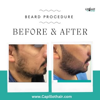 Dreaming of a fuller, natural-looking beard? 🌟 Our beard transplants offer precision and density fo