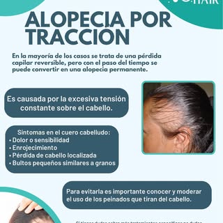 🌟 La alopecia por tracción es una condición que afecta a muchas personas y que puede ser causada po