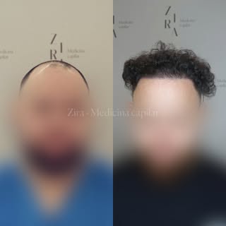 Hoy les traigo este caso donde trabajamos zona frontal, entradas y zona central con 3098 uf’s✨ 

Ten