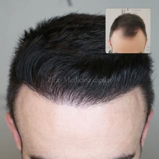 ✨ Antes y después ✨

Rellenar entradas y reconstruir una línea frontal no solo cambia el pelo: cambi