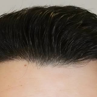 En este caso, el punto clave no era solo reconstruir la línea frontal.

Era conseguir que el resulta