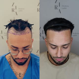Y aquí les dejo el carrusel de fotos de antes y después 🥰

- Rapado parcial ✅
- Reconstrucción de l