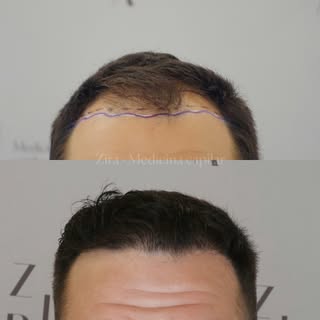 12 meses después… y esa zona frontal habla por sí sola 😍🔥