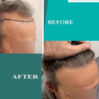 Before and after 4500 FUE Grafts!
🌐 www.hairtransplants-hdc.com
☎️ 00357 22346161

DM for a free pe