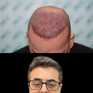4500 FUE Grafts !
🌐 www.hairtransplants-hdc.com
☎️ 00357 22346161

DM for a free personal evaluatio