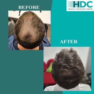 We are one of the top clinics in Europe offering state of the Art hair Transplantation.
With the hig