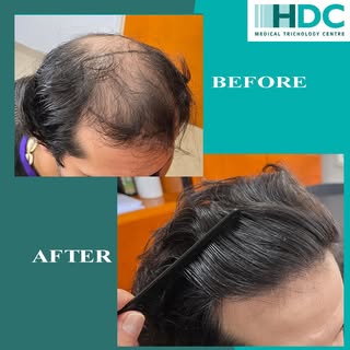Clinically precise…visibly natural! 

Before / After
5,000 FUE grafts

🌐 www.hairtransplants-hdc.co