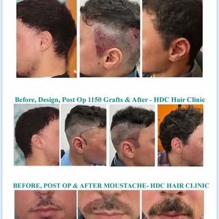 Facial hair restoration by Dr. Christina and HDC medical team.

📲For consultation WhatsApp +9725265