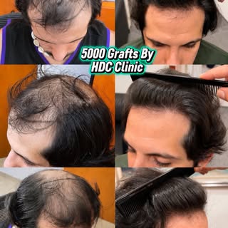15 months post result including donor recovery of the patient, notice how the donor looks untouchabl