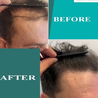 Before, After, WOW!
From hair loss to hair confidence!
Before and After 3800 FUE Grafts.

🌐 www.hai