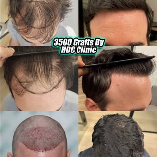 Hairline and Front Triangle Hair Transplantation using 3.500 FUE Grafts to a 33 years old patient. T