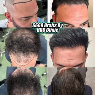 Front and Crown Restoration | 6,660 FUE Grafts | HDC Hair Clinic. 

At HDC Hair Clinic, we have been