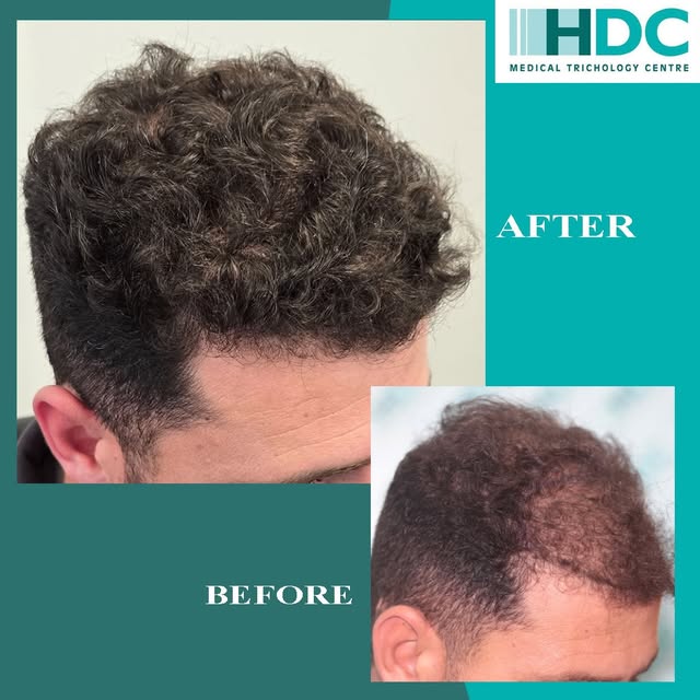 Density enhancement for 4.100 FUE Grafts. 

Density enhancement is a highly specialized type of hair