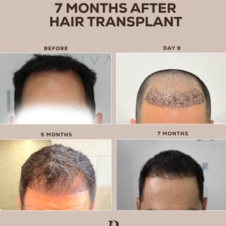 Hair restoration is a journey and every month brings visible progress.
From the first days of healin