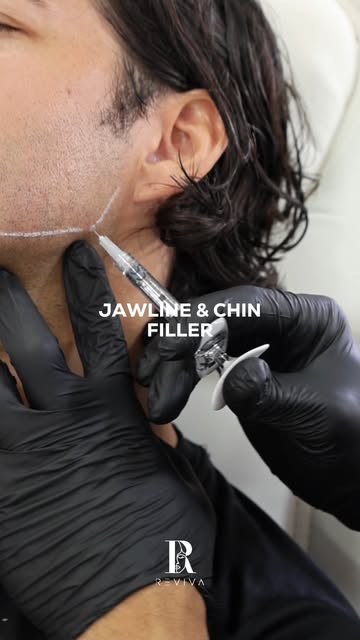 Subtle changes. Beautiful definition. Jawline and chin fillers are designed to enhance your natural 