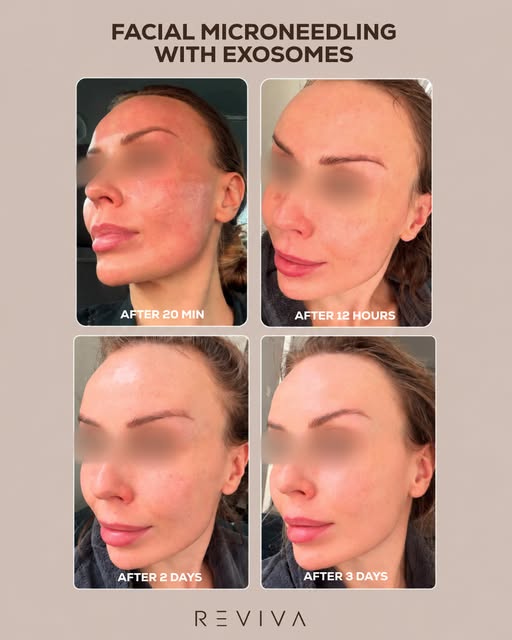 Facial Microneedling with Exosomes works across the entire face to support smoother, fresher-looking