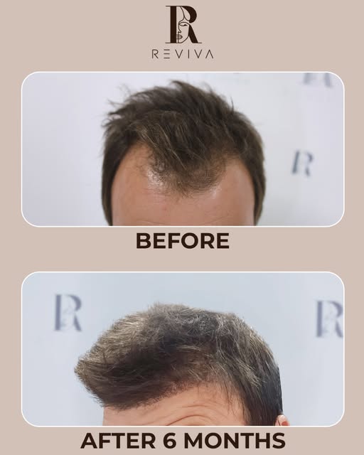 6 months. One powerful transformation. 

A natural-looking hairline, improved density and visible gr