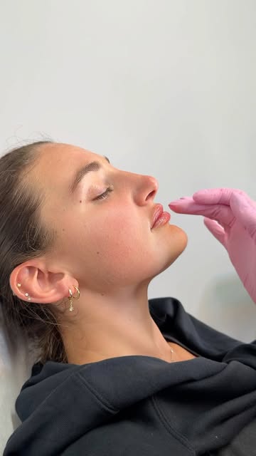 Perfection 🔥 #phillymedspa #phillyskincare #lipfiller #lipfillerbeforeandafter #juicylips