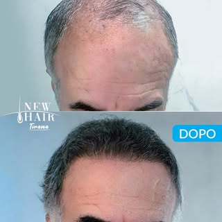 Il trapianto capelli non cambia solo l’aspetto: cambia il modo in cui ti senti ogni giorno. ✨

Chied