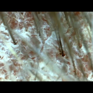 Psoriasis under the microscope:
Normally hair and skin have what’s called “immune privilege” They ar