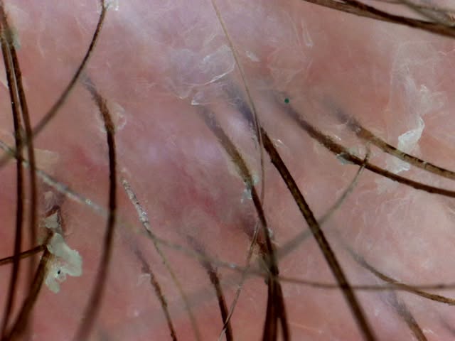 This scalp is screaming for exfoliation. Natural yeasts that feed off of sebum and sweat disrupt the